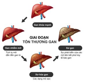 Viêm Gan B